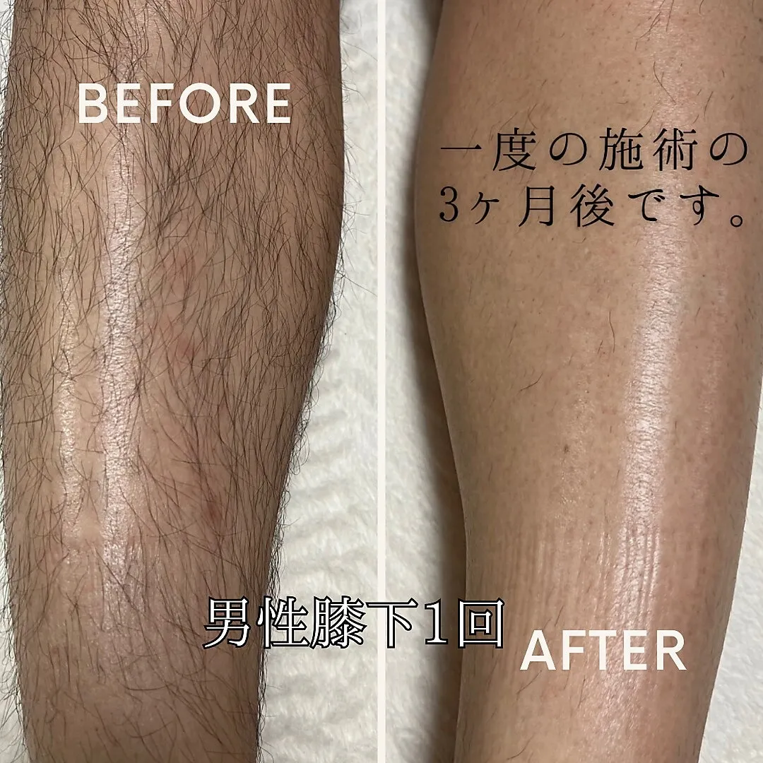 男性全身脱毛