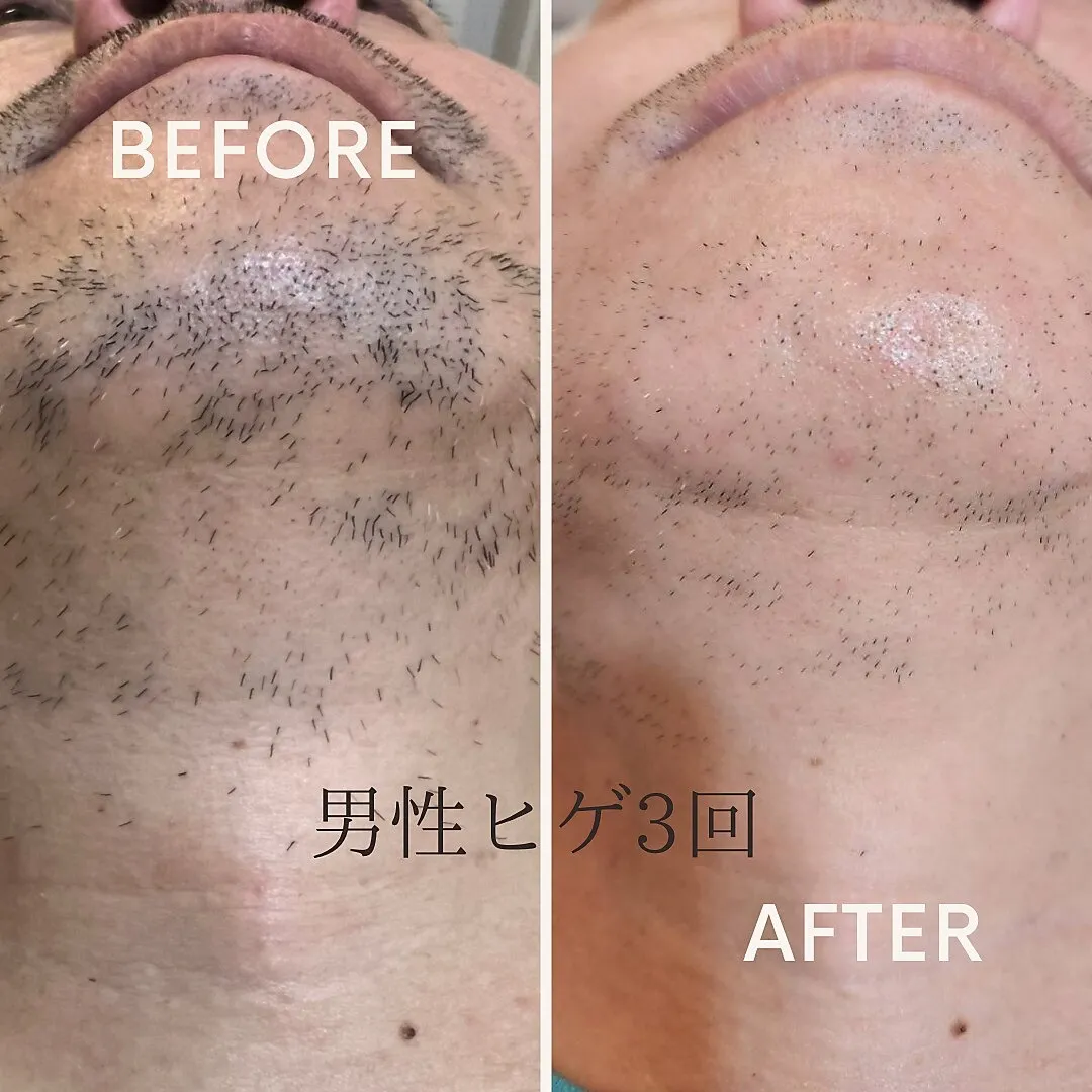 男性ヒゲ脱毛