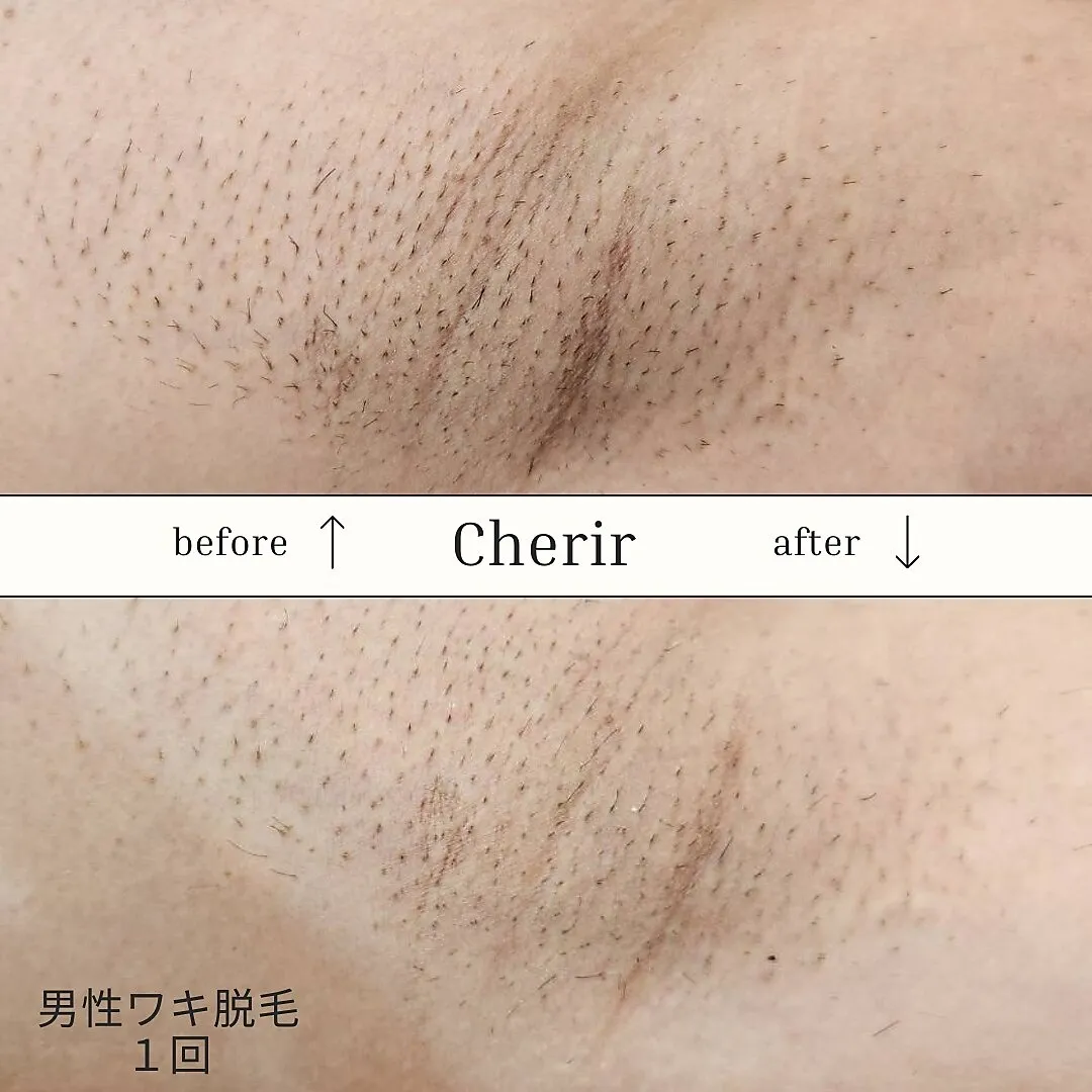  男性ワキ脱毛