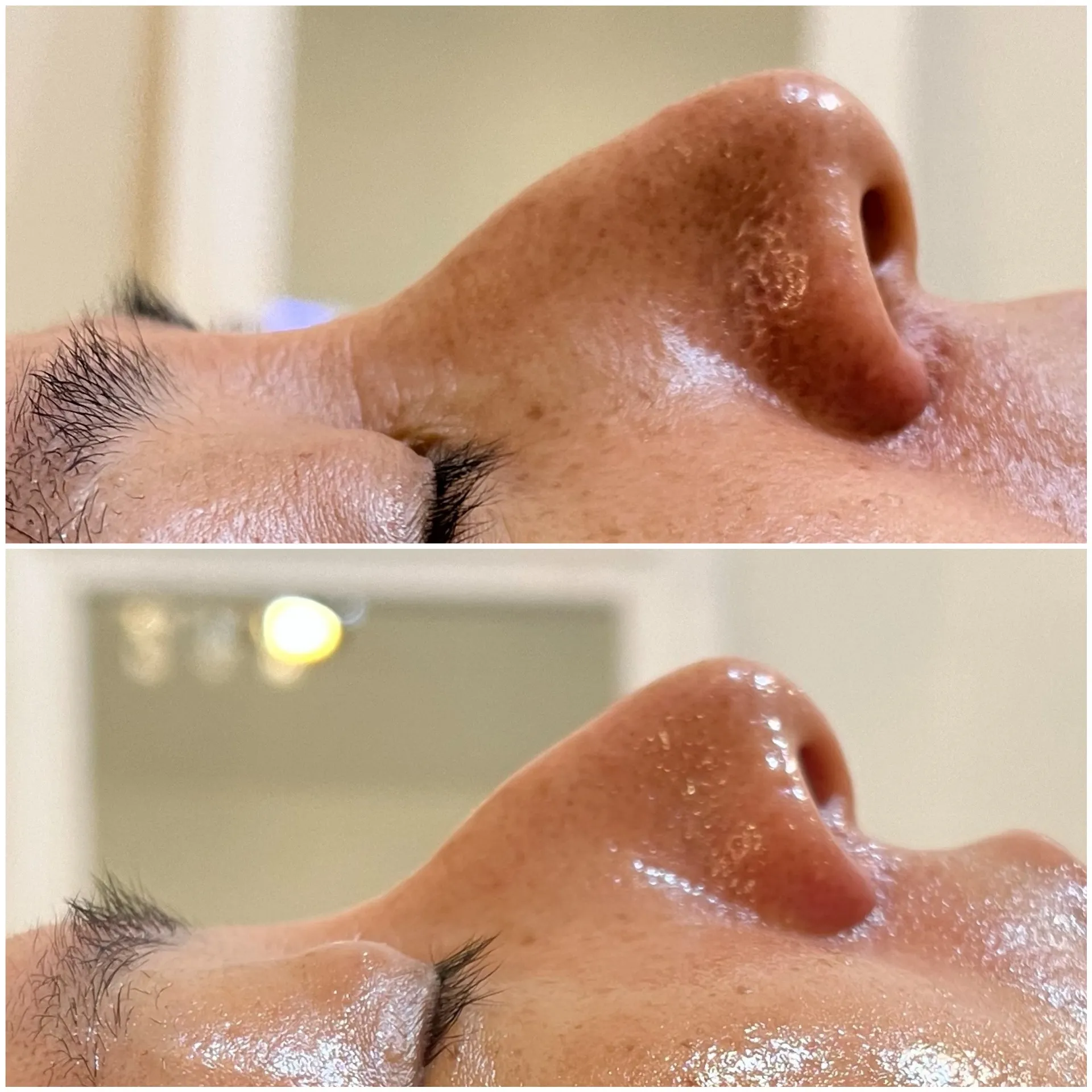 鳥取・倉吉で毛穴に悩む人必見！エステで改善、素肌に自信を